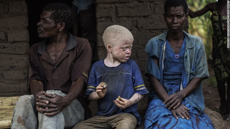 Malawi's albinos to contest in elections